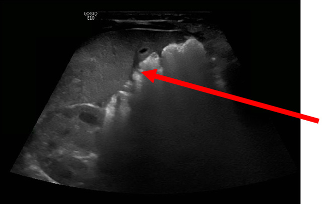 Bowel on ultrasound image.